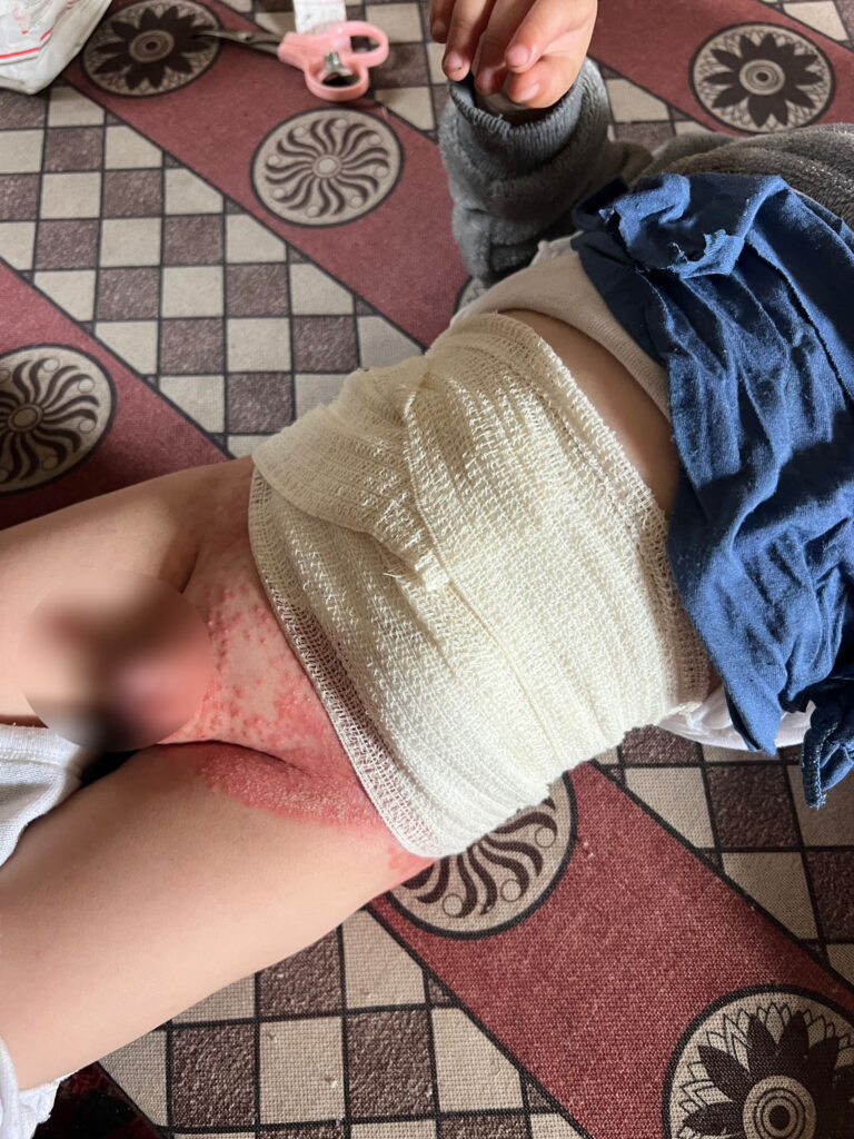 Association Amani - AMANI va prendre en charge l’intervention chirurgicale de l’enfant HANI de la bande de Gaza... - IMG 20250526 WA0001